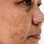 Reasons Of Pigmentation: हमारे चेहरे पर काले धब्बे क्यों बन जाते हैं, जानिए पिगमेंटेशन के 5 कारण