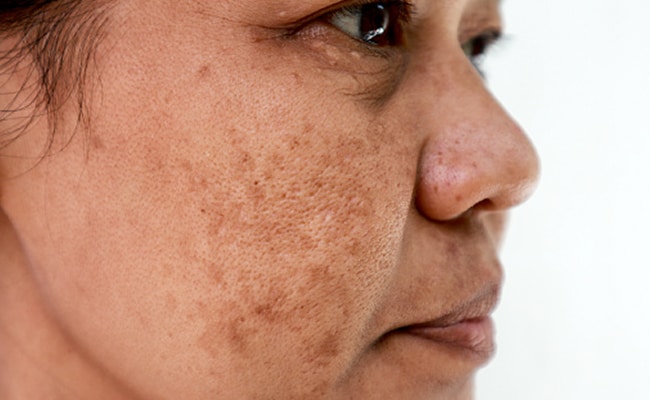 Reasons Of Pigmentation: हमारे चेहरे पर काले धब्बे क्यों बन जाते हैं, जानिए पिगमेंटेशन के 5 कारण